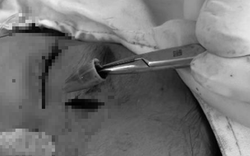 Bé trai đau vùng mắt dữ dội, bác sĩ sốc khi phát hiện dị vật "tàng hình"