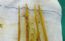 Cô gái 26 tuổi đau bụng dữ dội, bác sĩ “chết lặng” khi phát hiện thứ bên trong