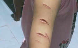 Hé lộ nguyên nhân học sinh lớp 5 bị chị họ dùng dao rạch nhiều nhát lên tay