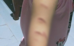 Vụ bé gái bị chị họ 12 tuổi dùng dao rạch khắp người: Mâu thuẫn từ việc em giật áo chị rủ chơi cùng