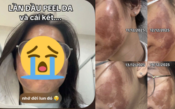 Cô gái “banh mặt” khi peel da ở spa: Suýt mất Tết, tốn 10 lần tiền chữa nỗi đau