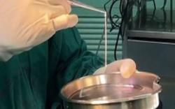 Người phụ nữ 32 tuổi đi ngoài ra sán dài tới 3 mét dù chưa từng ăn đồ sống, bác sĩ chỉ ra 1 thứ bếp nhà nào cũng có chính là thủ phạm