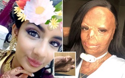 Dầu gội đầu bắt lửa, cô gái bị bỏng nửa người và mất 7 ngón tay