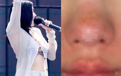 Nữ hoàng gợi cảm showbiz bị bỏng mặt, xót cho nhan sắc trời ban