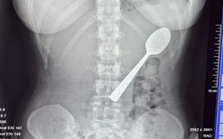 Đang ăn sữa chua, người phụ nữ nuốt chiếc thìa dài 17cm vào bụng