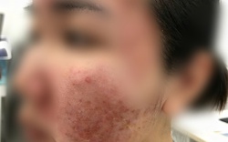 Cơn ác mộng của thiếu nữ chỉ sau vài giờ được mời làm đẹp cấp tốc đón Tết