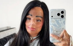 Dầu gội đầu bắt lửa, cô gái xinh đẹp bị bỏng nửa người và cái kết bất ngờ