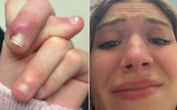 Người phụ nữ 21 tuổi suýt mất ngón vì thói quen "vạn người mê"