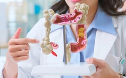 Ung thư đại trực tràng gia tăng ở người trẻ: Đây là 11 cách phòng ngừa, bạn làm được mấy?