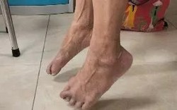 Hội chứng Guillain-Barré: "Kẻ ẩn danh" dễ gây nhầm lẫn trong thần kinh học