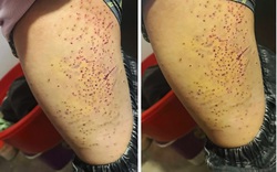 Nữ sinh lớp 7 dùng bút bi đâm hơn 20 lần lần vào đùi bạn học: Đây là nguyên nhân