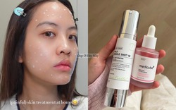Serum vi kim: Bôi lên là thấy châm chích nhẹ, da cải thiện thấy rõ nhưng cần thời gian làm quen