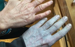 Toàn thân tím tái, người đàn ông vội đến bệnh viện và cái kết