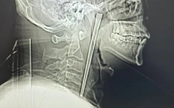 Người đàn ông đau họng dữ dội, bác sĩ lấy ra thứ đáng sợ bên trong