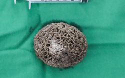 Người đàn ông 50 tuổi đau hạ vị kéo dài, bác sĩ sốc khi gắp ra thứ "đáng sợ" bằng quả trứng ngỗng