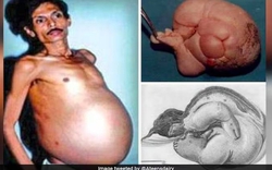 Người đàn ông 60 tuổi "mang thai" suốt 36 năm, nhóm bác sĩ kinh hoàng khi tiến hành phẫu thuật