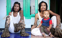 42 năm cuộc đời đầy bi kịch của "người cây"