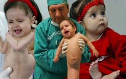 Nàng tiên cá ngoài đời thực: Bé gái chào đời với đôi chân dính liền và 15 năm sống năm phi thường như "một kỳ tích y học"