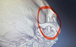 Chàng trai đau thái dương suốt 13 năm, bác sĩ phát hiện ra bí mật "đáng sợ" bên trong