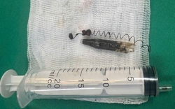 Mang đầu bút bi trong mặt suốt 13 năm không hay biết