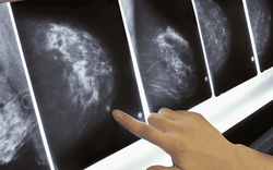 Người phụ nữ không đau, không u vẫn mắc ung thư vú: BS ung bướu cảnh báo 3 việc chị em phải làm đều đặn để bảo vệ mình