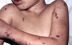 Cảnh báo bệnh não mô cầu ở trẻ: Dễ nhầm cảm cúm, nguy cơ tử vong cao