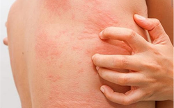 Thấy vàng da kèm ngứa, người phụ nữ đi khám phát hiện mắc 2 loại ung thư: Bệnh viện Bạch Mai nói quá hiếm gặp, thách thức trong chẩn đoán