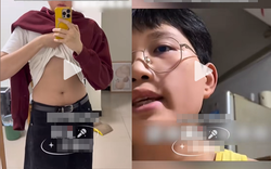 Nam thanh niên 32 tuổi mới "dậy thì", phát triển ngực như phụ nữ, bác sĩ sốc khi nồng độ hormone nam chỉ dưới 0.1