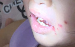 TP Hồ Chí Minh: Tay chân miệng tăng mạnh, sốt xuất huyết giảm