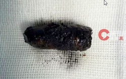 Mũi người đàn ông chảy dịch dai dẳng, bác sĩ phát hiện bí mật đáng sợ