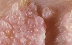 Người đàn ông gần 70 tuổi mắc sùi mào gà sau quan hệ không an toàn