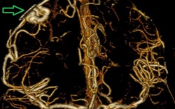 Bác sĩ cảnh báo "quả bom nổ chậm" trong não: Người trẻ dễ chủ quan với dấu hiệu này