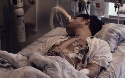 Nam sinh 18 tuổi tử vong vì ung thư đại trực tràng, bác sĩ: "Thủ phạm" là món thịt thơm lừng, trẻ em Việt rất thích