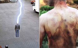 Người đàn ông sống sót sau 4 lần bị sét đánh, kể lại điều thực sự xảy ra với cơ thể mình