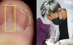 Người phụ nữ 45 tuổi phát hiện khối u từ 1 dấu hiệu ở móng tay nhiều người bỏ qua