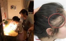 Thức khuya kèm con học, mẹ rụng tóc đến hói cả đầu!