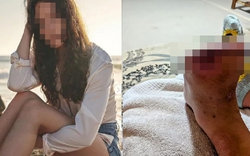 Cô gái 20 tuổi hoại tử, phải cắt bỏ 2 ngón chân vì mỗi ngày đều uống 1 loại nước "vạn người thích"
