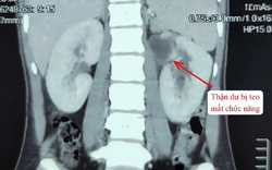 Kỳ lạ cô gái 22 tuổi có 3 quả thận