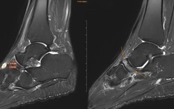 4 thói quen âm thầm ''ăn mòn'' xương ở người trên 40 tuổi