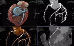 Bệnh nhân thoát nguy cơ ‘thượng mã phong’ nhờ chia sẻ chuyện phòng the
