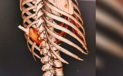 Người phụ nữ nhập viện với con dao Thái Lan cắm trên lưng