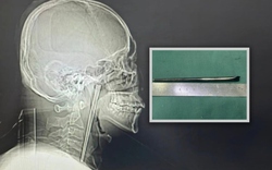 Người đàn ông sống 8 năm với chiếc đũa trong cổ họng và cái kết khiến cộng đồng mạng không thể tin nổi