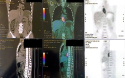 Nuốt nghẹn, sụt 5 kg, đi khám phát hiện mắc hai loại ung thư