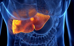 1 dấu hiệu “khó chịu” có thể là tín hiệu cho thấy gan đang suy hỏng nặng: Nếu có cần đi khám ngay