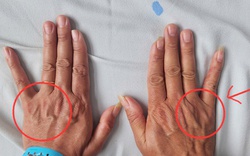 Tê ngón tay út tưởng chuyện nhỏ, người đàn ông 51 tuổi suýt bị teo cả bàn tay