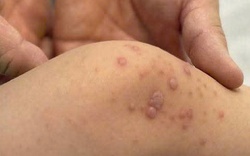 Bệnh tay chân miệng tăng nhanh, bác sĩ cảnh báo nóng