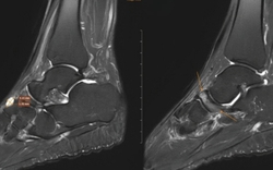 Nữ giáo viên đi khám đau cổ chân, bất ngờ phát hiện bị bệnh 'triệu người có một'