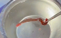 Người đàn ông 53 tuổi chảy máu mũi liên tục, bác sĩ phát hiện ra thứ "đáng sợ" ẩn náu bên trong