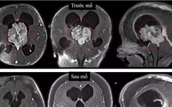 Bé sơ sinh bị u não, bác sĩ cảnh báo dấu hiệu cần nhập viện ngay