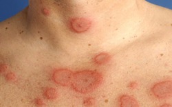 Căn bệnh nguy hiểm chỉ 10% được chẩn đoán sớm, có người vài năm mới phát hiện